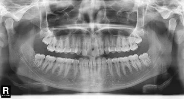 Ortopantomografický snímek (OPG)